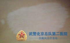 白癜风如何确诊 白癜风如何确诊