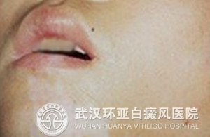 儿童白癜风的病因有哪些
