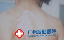 白癜风稳定期症状表现如何