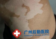 广东白癜风医院哪家好 广东白癜风医院哪家好