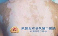 北京白癜风去哪家医院好 北京白癜风去哪家医院好