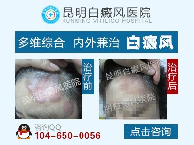 昆明白癜风专科医院是哪家啊