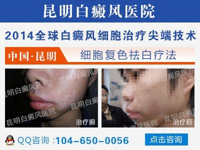 昆明白癜风专科医院网站