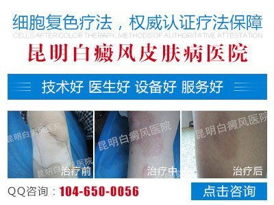 昆明白癜风专科医院有哪些