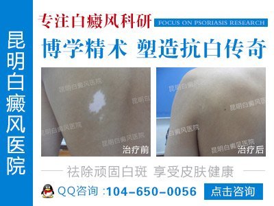 昆明白癜风专治医院
